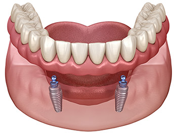 3D illustration of implant-supported upper and lower dentures