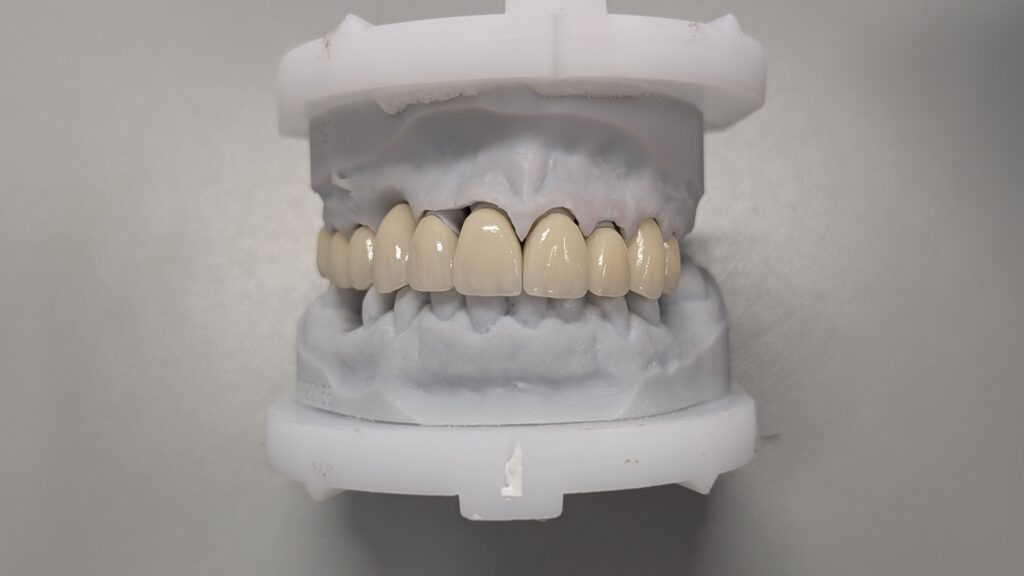 Dental model used to plan crowns, dentures, and bridges