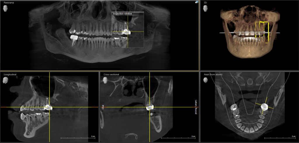 Dental X-ray showing cross-sectional bone structure for implant planning