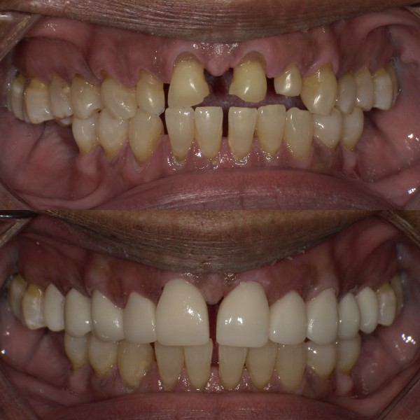 Before-and-after cosmetic restoration of worn and discolored teeth