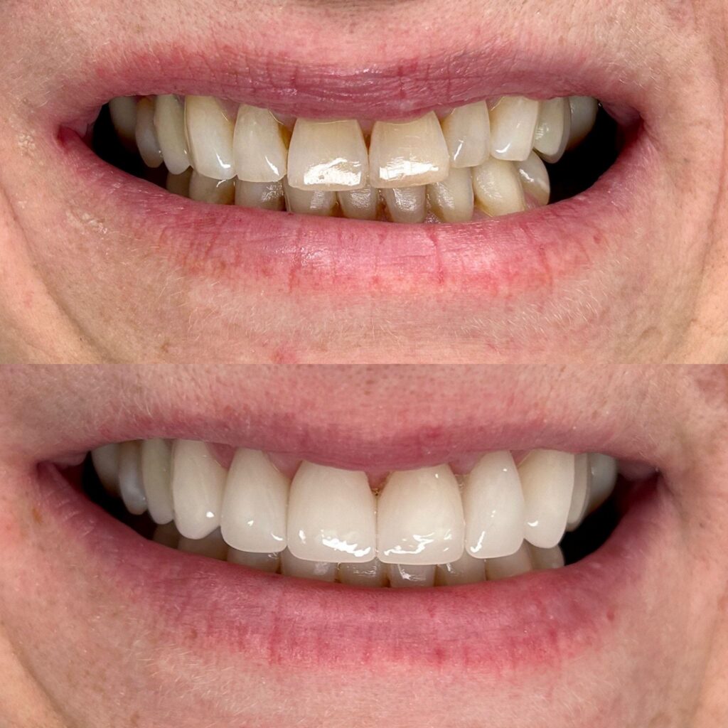 Before-and-after teeth whitening results