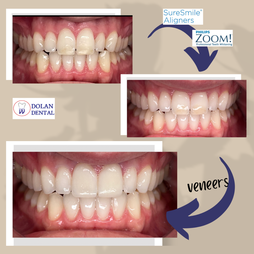Before-and-after smile transformed with clear aligners and whitening