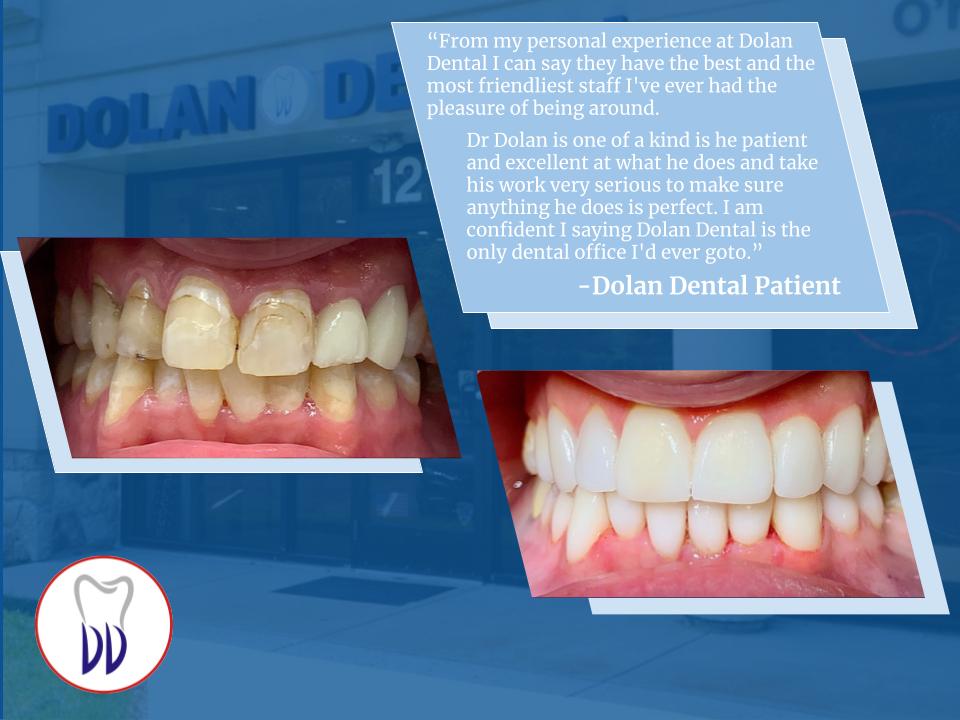 Before-and-after photos showing repaired chipped and discolored teeth