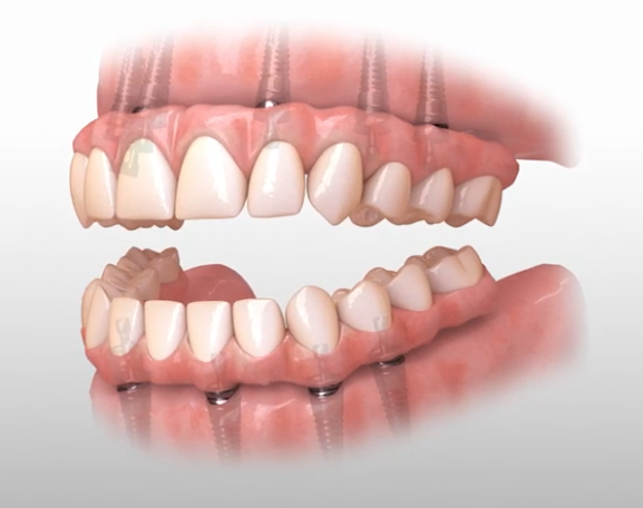 Illustration of upper and lower full-arch restorations supported by dental implants