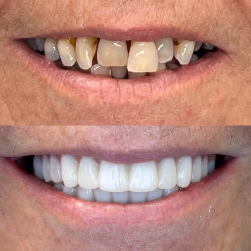 Before-and-after full-arch restoration replacing missing and damaged teeth