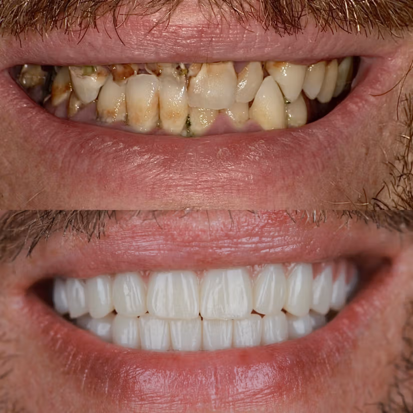 Before-and-after restoration of damaged and discolored teeth