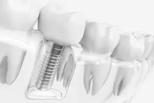 Illustration of a single dental implant replacing a missing tooth