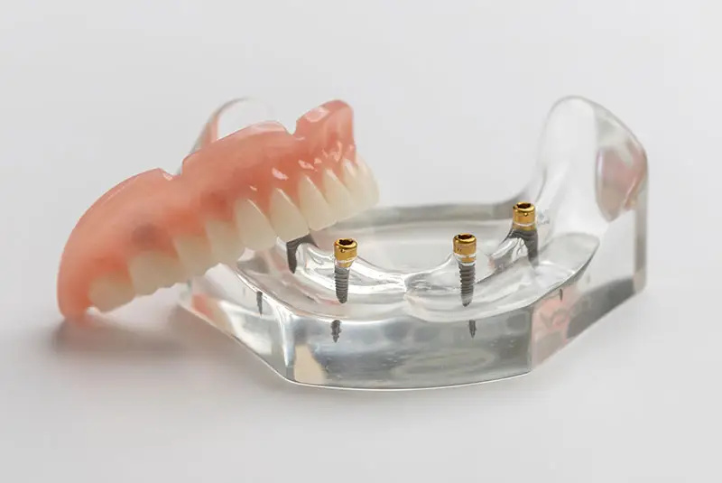 Removable snap-on denture positioned above four dental implants in a lower-jaw model