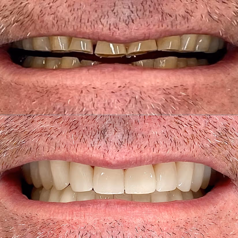 Before-and-after full-arch implant smile transformation