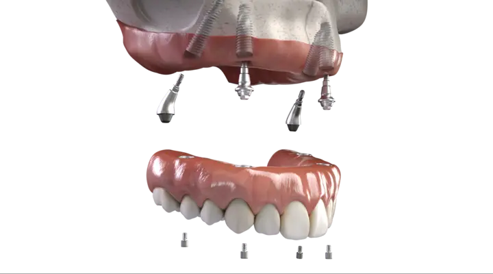 Diagram of upper and lower implant-supported full-arch dentures